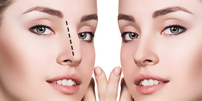Rinoplastia costo