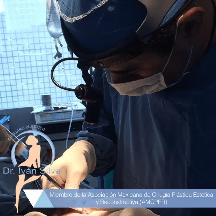 Aumento de gluteos en mexico | Dr. Ivan Silva